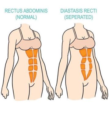 Diastasis Recti